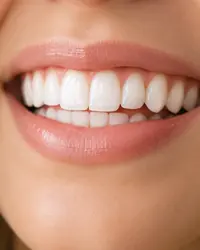 Close-up of a smile after teeth whitening